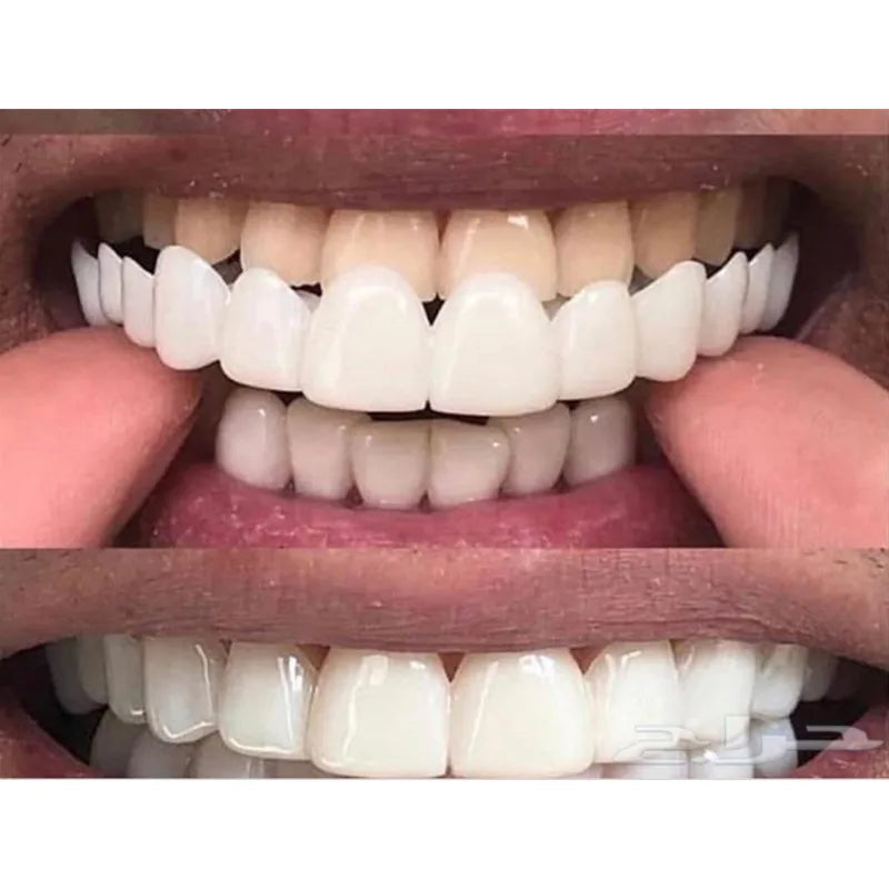 Brackets de silicona: carillas dentales removibles para una sonrisa perfecta 