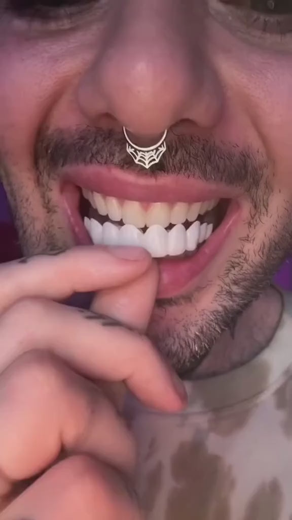 Brackets de silicona: carillas dentales removibles para una sonrisa perfecta 